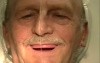 Dentures - Wax Rim Appointment - Wax Esthetics, Speech, CR, VDO