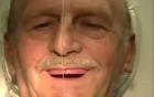 Dentures - Wax Rim Appointment - Wax Esthetics, Speech, CR, VDO
