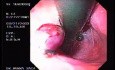 Banding of esophageal varices (8 of 17)