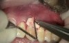 How To Deal With Recessions - Purified Collagen Implant