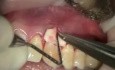 How To Deal With Recessions - Purified Collagen Implant