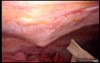 Colonic Perforation With Peritonitis - Laparoscopy (46 of 46)