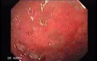 Multiple Rectal Ulcers (3 of 110)