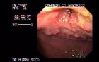 Pre - Pyloric Gastric Carcinoma - Endoscopy (1 of 2)