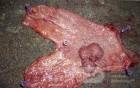 Polypoid Adenocarcinoma (2 of 9)