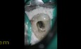 Mandibular premolar with 3 canals