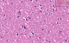 Hemorrhage - Histopathology of brain