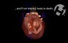 Ventricular Rupture