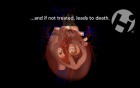 Ventricular Rupture