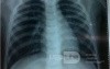 Bronchopneumonia