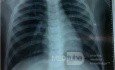 Bronchopneumonia
