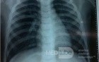 Bronchopneumonia