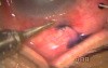 Absolute Glaucoma & Non-healing Corneal Ulcer - TCF