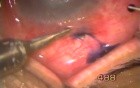 Absolute Glaucoma & Non-healing Corneal Ulcer - TCF