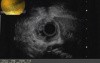 EUS resection of duodenal polyps