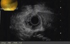 EUS resection of duodenal polyps