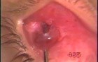 Inferior Oblique Myomectomy - Fugo Blade