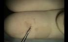 Dental Implant Microsurgery: Untreatable Root Resorption