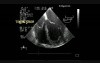 Infective Endocarditis: Vegetation On The Pacemaker Lead