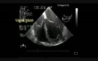 Infective Endocarditis: Vegetation On The Pacemaker Lead