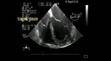 Infective Endocarditis: Vegetation On The Pacemaker Lead
