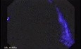 Sessile Tubulovillous Adenoma (3 of 11)