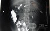 Multiple Foreign bodies in the GI tract (12 of 12)