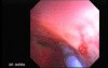 Upper Gastrointestinal Bleeding - Beginning of the Argon Plasma Coagulation