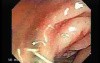 Adenocarcinoma - Cecum (2 of 4)