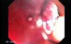 Colonoscopic Polypectomy (15 of 23)