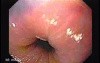 Barrett Esophagus -vital staining with Lugol's solution (4 of 6)