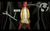 Surgical Repair Option for Aortic Aneurysm