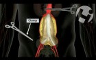 Surgical Repair Option for Aortic Aneurysm