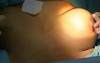 Semielastic Scarless Mastopexy