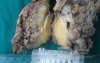 Synchronous Cancers, Familial Adenomatous Polyposis (34 of 36)