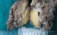 Synchronous Cancers, Familial Adenomatous Polyposis (34 of 36)