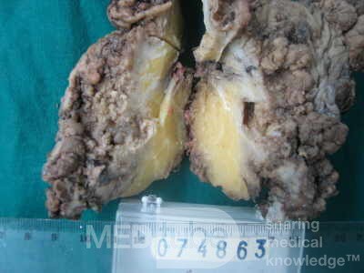 Synchronous Cancers, Familial Adenomatous Polyposis (34 of 36)