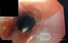 Ectopic Gastric Mucosa (Inlet Patch)