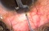 Transciliary filtration - bleeding