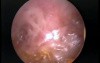 Mastoid Cavity - Left Ear