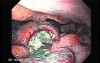 Multiple Irregular and Large Ulcers - Biopsy nr 2