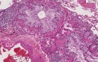 Lung - Asthma