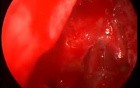 FESS - Method Description - Updated