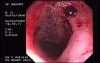 Radiation Proctosigmoiditis (2 of 14)