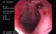 Radiation Proctosigmoiditis (2 of 14)