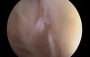 Arthroscopy- Fluid: Scapulohumeral Joint
