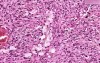 Metastatic liposarcoma - Histopathology - Diaphragm