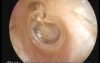 Attic Retraction Pocket with Scutum Resorption