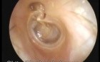 Attic Retraction Pocket with Scutum Resorption