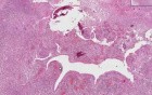 Wegener granulomatosis - Histopathology - Lung